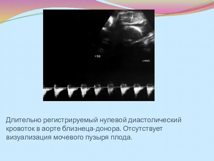 Длительно регистрируемый нулевой диастолический кровоток в аорте близнеца-донора. Отсутствует визуализация мочевого пузыря плода.
