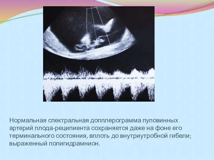 Нормальная спектральная допплерограмма пуповинных артерий плода-реципиента сохраняется даже на фоне