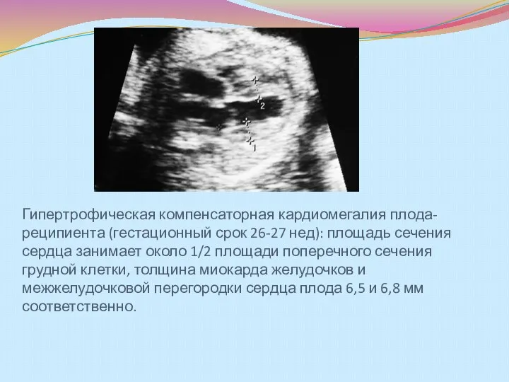 Гипертрофическая компенсаторная кардиомегалия плода-реципиента (гестационный срок 26-27 нед): площадь сечения