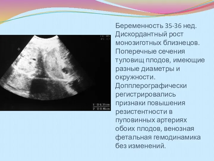 Беременность 35-36 нед. Дискордантный рост монозиготных близнецов. Поперечные сечения туловищ