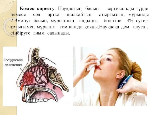 Көмек көрсету: Науқастың басын вертикальды түрде немесе сәл артқа шалқайтып