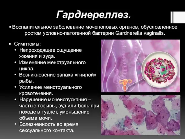 Гарднереллез. Воспалительное заболевание мочеполовых органов, обусловленное ростом условно-патогенной бактерии Gardnerella