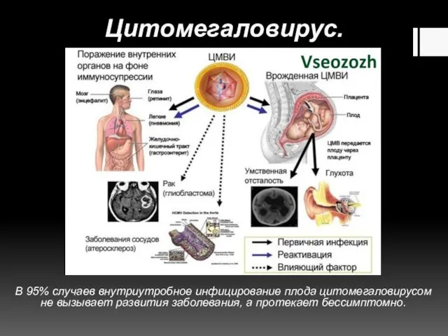 Цитомегаловирус. В 95% случаев внутриутробное инфицирование плода цитомегаловирусом не вызывает развития заболевания, а протекает бессимптомно.