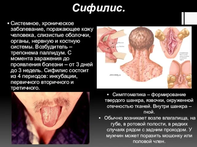 Сифилис. Системное, хроническое заболевание, поражающее кожу человека, слизистые оболочки, органы,