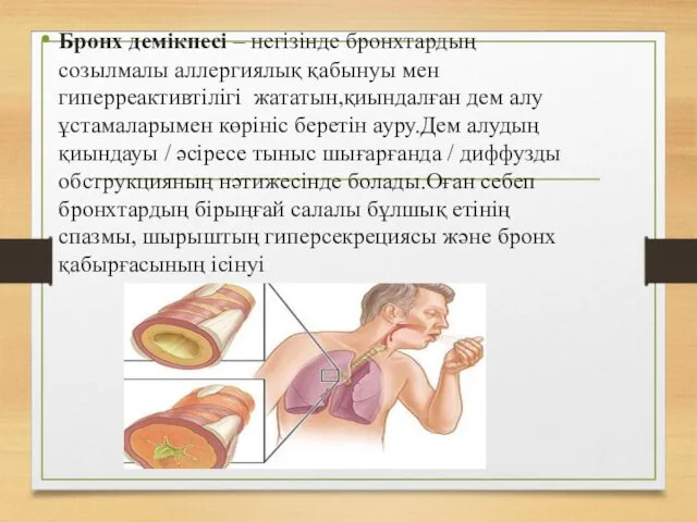 Бронх демікпесі – негізінде бронхтардың созылмалы аллергиялық қабынуы мен гиперреактивтілігі