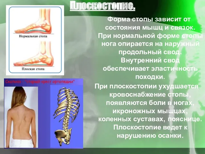 Плоскостопие. Форма стопы зависит от состояния мышц и связок. При