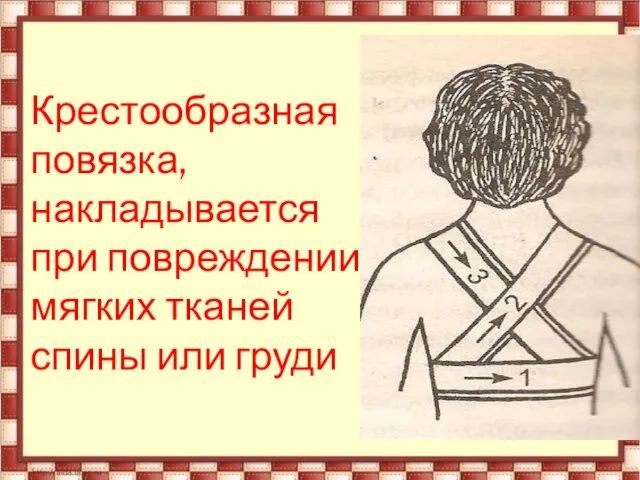 Крестообразная повязка, накладывается при повреждении мягких тканей спины или груди