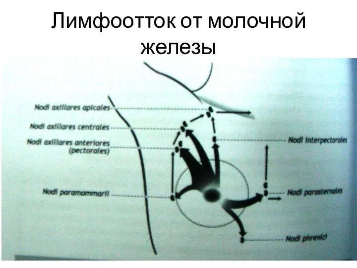 Лимфоотток от молочной железы