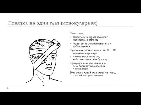 Повязка на один глаз (монокулярная) Показания: закрепление перевязочного материала в области глаза при