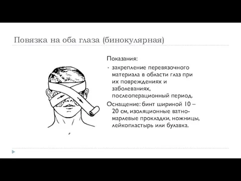 Повязка на оба глаза (бинокулярная) Показания: закрепление перевязочного материала в области глаз при