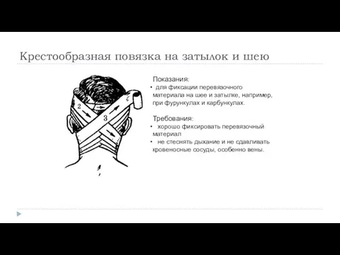 Крестообразная повязка на затылок и шею Показания: для фиксации перевязочного материала на шее