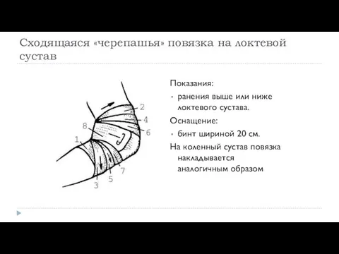 Сходящаяся «черепашья» повязка на локтевой сустав Показания: ранения выше или ниже локтевого сустава.