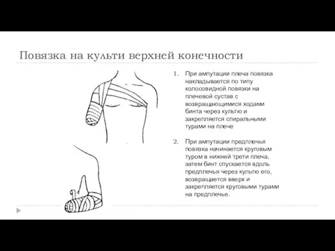 Повязка на культи верхней конечности При ампутации плеча повязка накладывается по типу колосовидной