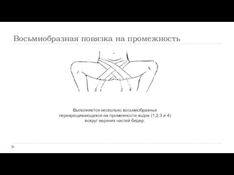 Восьмиобразная повязка на промежность Выполняется несколько восьмиобразных перекрещивающихся на промежности ходов (1,2,3 и