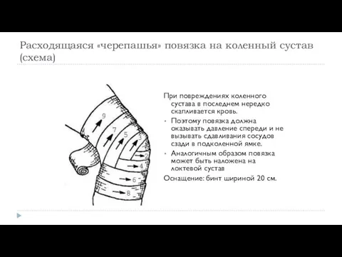 Расходящаяся «черепашья» повязка на коленный сустав (схема) При повреждениях коленного сустава в последнем