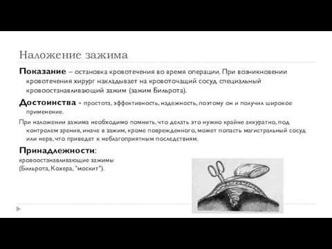 Наложение зажима Показание – остановка кровотечения во время операции. При возникновении кровотечения хирург