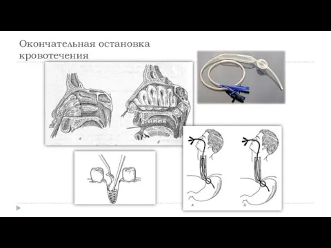 Окончательная остановка кровотечения