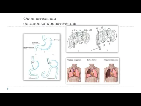 Окончательная остановка кровотечения