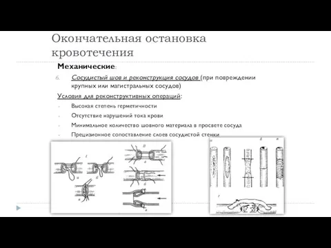 Окончательная остановка кровотечения Механические: Сосудистый шов и реконструкция сосудов (при повреждении крупных или