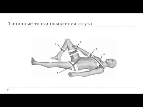 Типичные точки наложения жгута