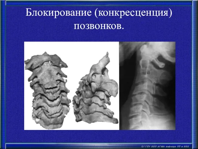 Блокирование (конкресценция) позвонков.