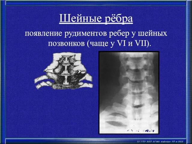 Шейные рёбра появление рудиментов ребер у шейных позвонков (чаще у VI и VII).