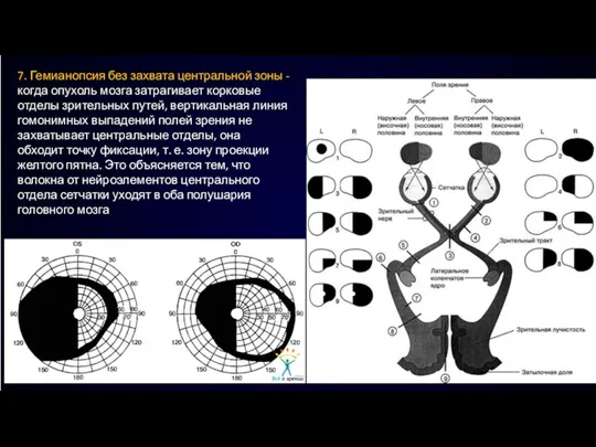 7. Гемианопсия без захвата центральной зоны - когда опухоль мозга