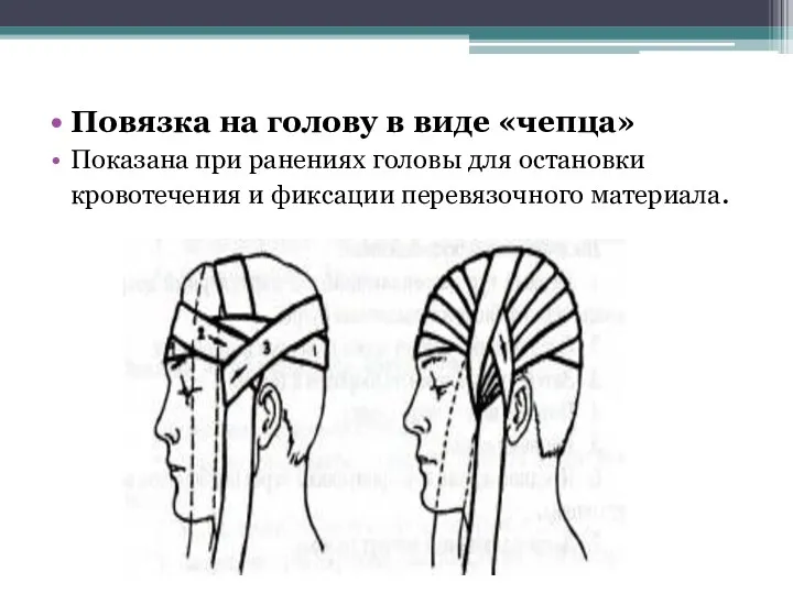 Повязка на голову в виде «чепца» Показана при ранениях головы