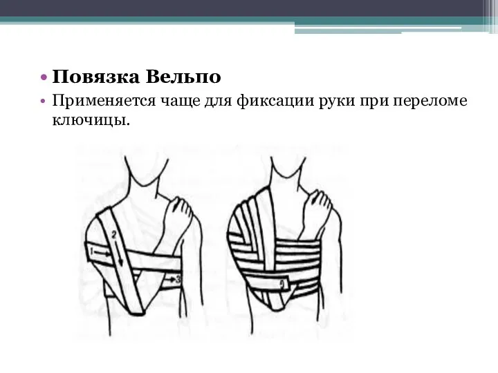 Повязка Вельпо Применяется чаще для фиксации руки при переломе клю­чицы.