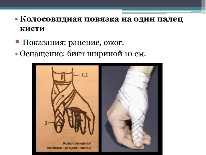 Колосовидная повязка на один палец кисти Показания: ранение, ожог. Оснащение: бинт шириной 10 см.