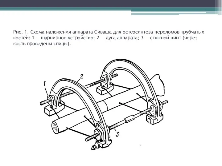 Рис. 1. Схема наложения аппарата Сиваша для остеосинтеза переломов трубчатых