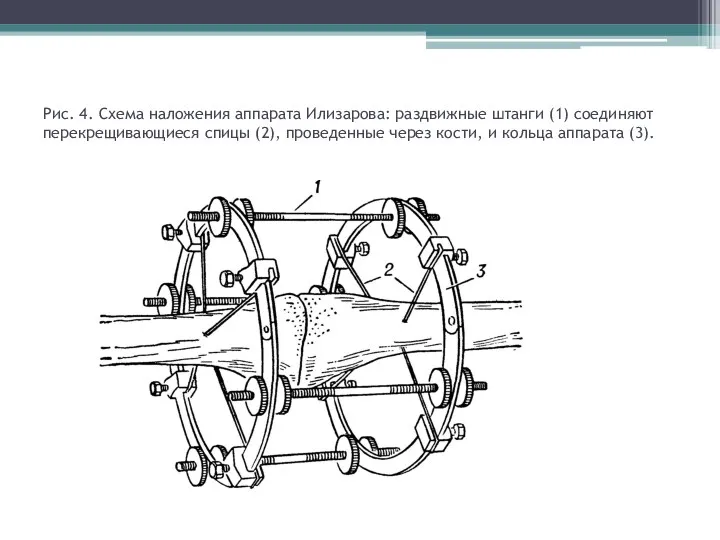 Рис. 4. Схема наложения аппарата Илизарова: раздвижные штанги (1) соединяют