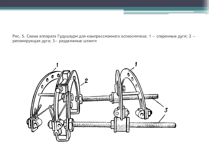 Рис. 5. Схема аппарата Гудушаури для компрессионного остеосинтеза: 1 —