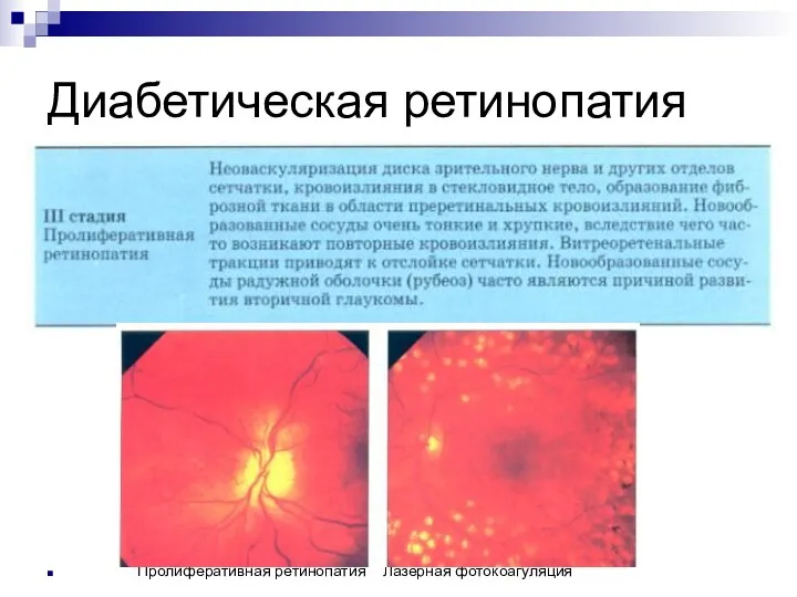 Диабетическая ретинопатия Пролиферативная ретинопатия Лазерная фотокоагуляция