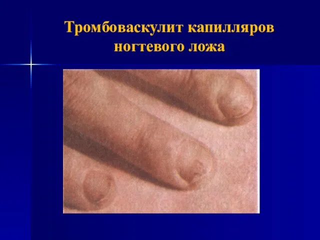 Тромбоваскулит капилляров ногтевого ложа