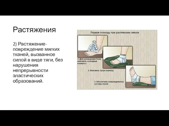 Растяжения 2) Растяжение- повреждение мягких тканей, вызванное силой в виде тяги, без нарушения непрерывности эластических образований.