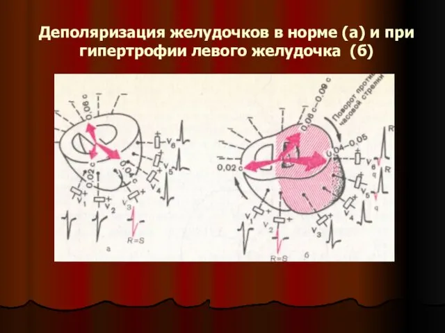 Деполяризация желудочков в норме (а) и при гипертрофии левого желудочка (б)