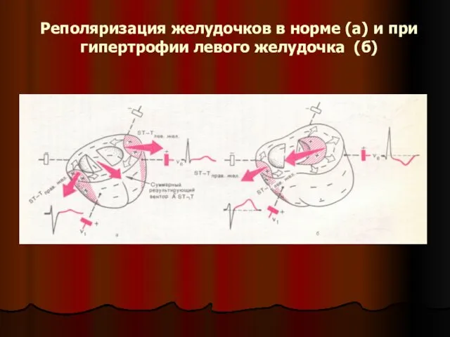 Реполяризация желудочков в норме (а) и при гипертрофии левого желудочка (б)