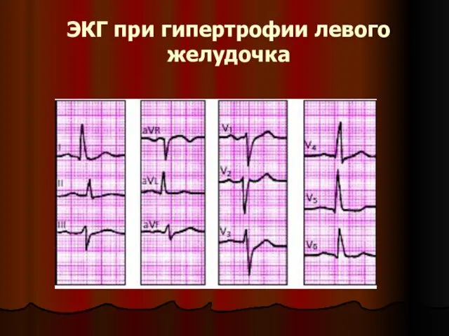 ЭКГ при гипертрофии левого желудочка