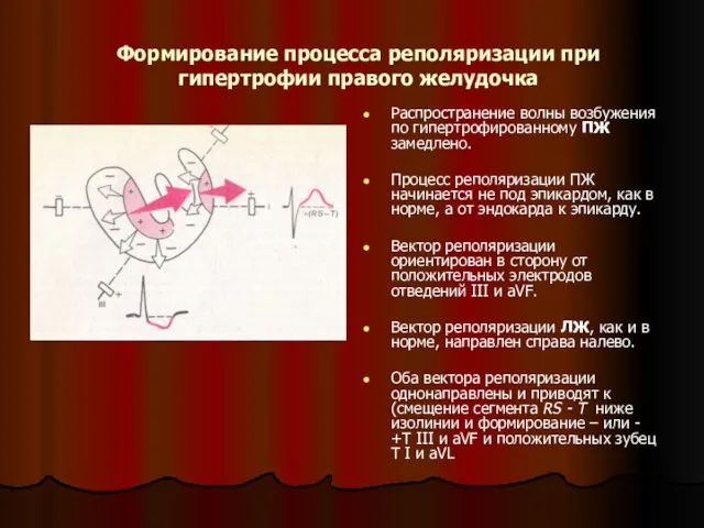 Формирование процесса реполяризации при гипертрофии правого желудочка Распространение волны возбужения по гипертрофированному ПЖ