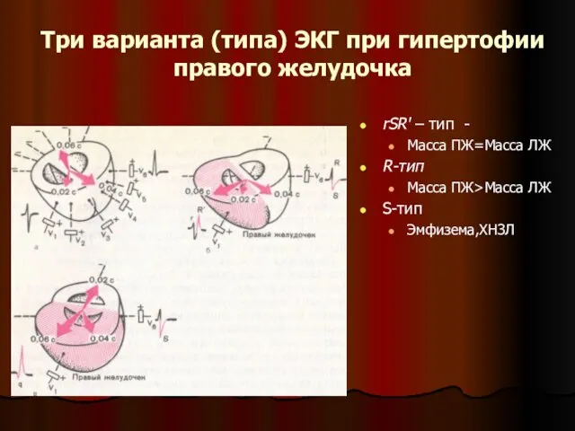 Три варианта (типа) ЭКГ при гипертофии правого желудочка rSR' –