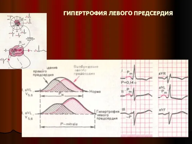 ГИПЕРТРОФИЯ ЛЕВОГО ПРЕДСЕРДИЯ