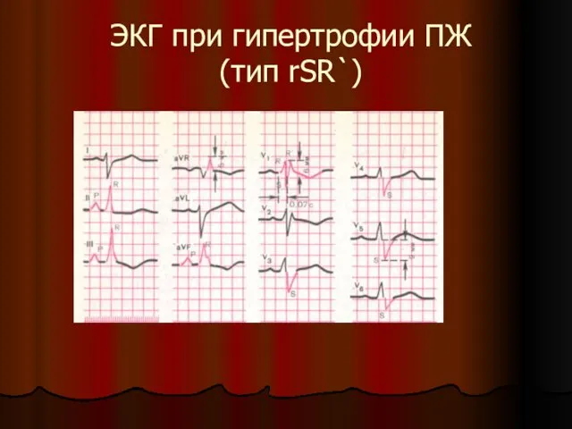 ЭКГ при гипертрофии ПЖ (тип rSR`)