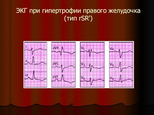 ЭКГ при гипертрофии правого желудочка (тип rSR')