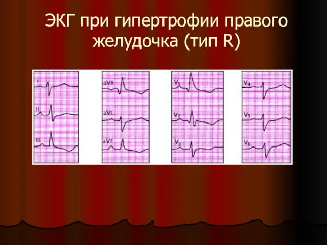 ЭКГ при гипертрофии правого желудочка (тип R)