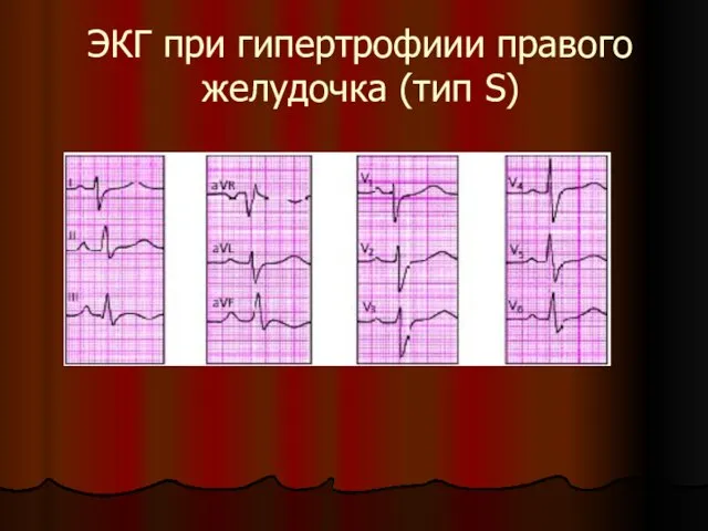 ЭКГ при гипертрофиии правого желудочка (тип S)