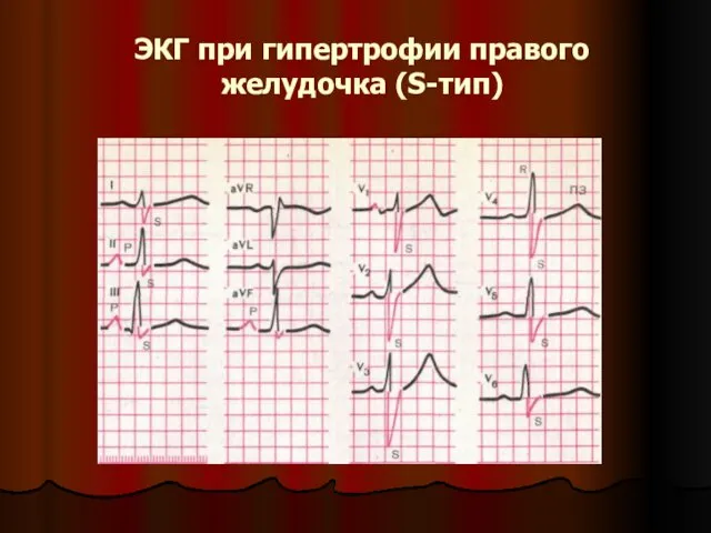 ЭКГ при гипертрофии правого желудочка (S-тип)