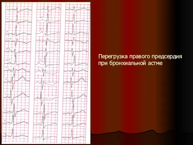 Перегрузка правого предсердия при бронхиальной астме