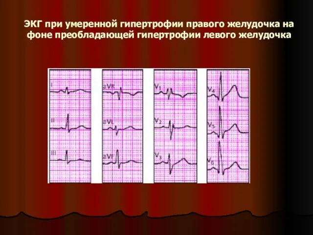 ЭКГ при умеренной гипертрофии правого желудочка на фоне преобладающей гипертрофии левого желудочка