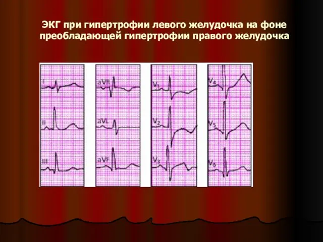 ЭКГ при гипертрофии левого желудочка на фоне преобладающей гипертрофии правого желудочка